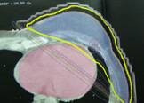 Breast Cancer