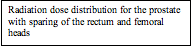 Text Box: Radiation dose distribution for the prostate with sparing of the rectum and femoral heads