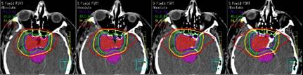 Brain Tumors